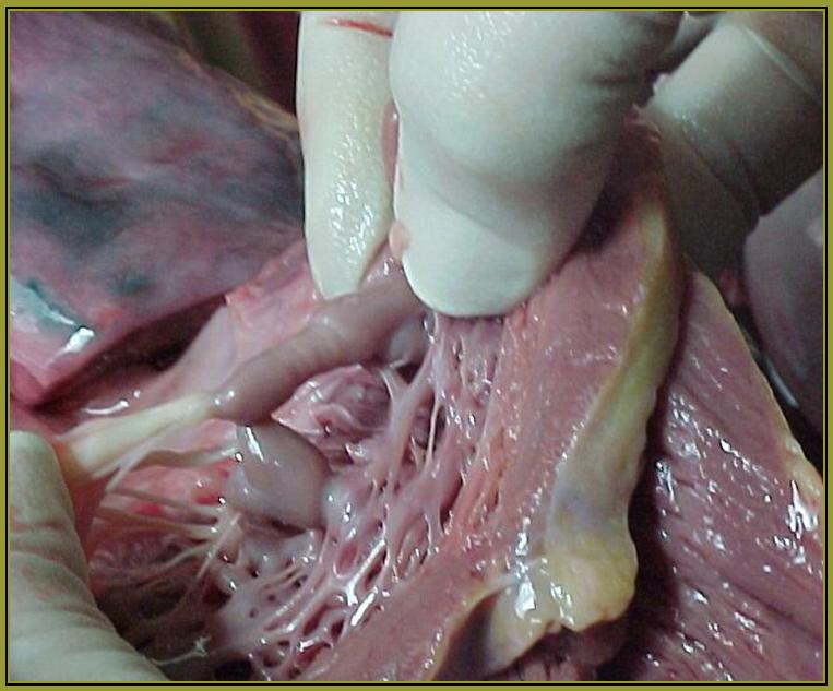 Imagen No. 4 - Fibrosis de la cuerda. Fusin y torsin de msculos papilares.